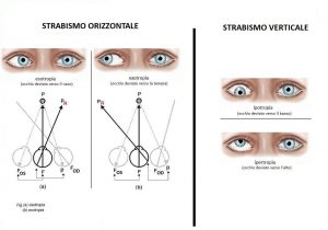 strabism-1