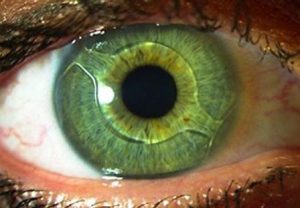 intra-ocular contact lenses